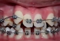 치아 교정을 추천하는 이유. 치아 교정을 추천하는 이유. - 관련 글 썸네일